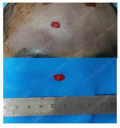 clinical photo of the mass