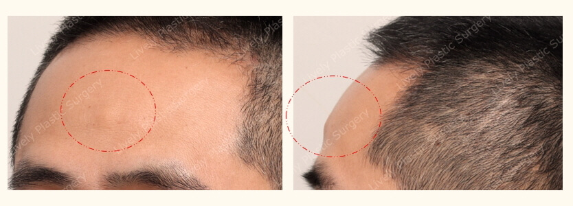 clinical photo of the forehead lipoma