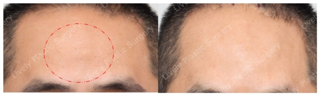 forehead lipoma frontal view