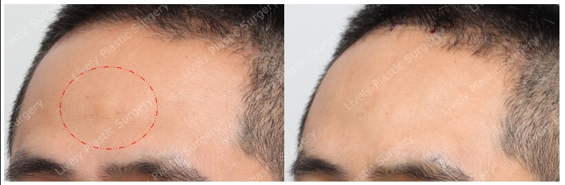 forehead lipoma quarter view