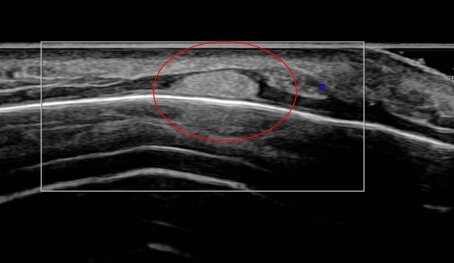 ultrasound image of the forehead lipoma