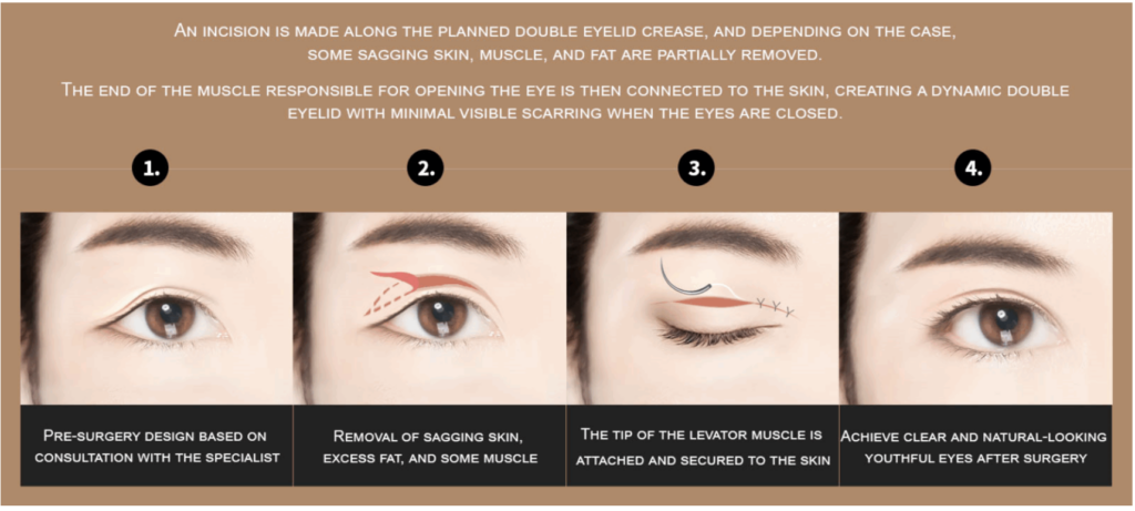 Steps of Lower Blepharoplasty