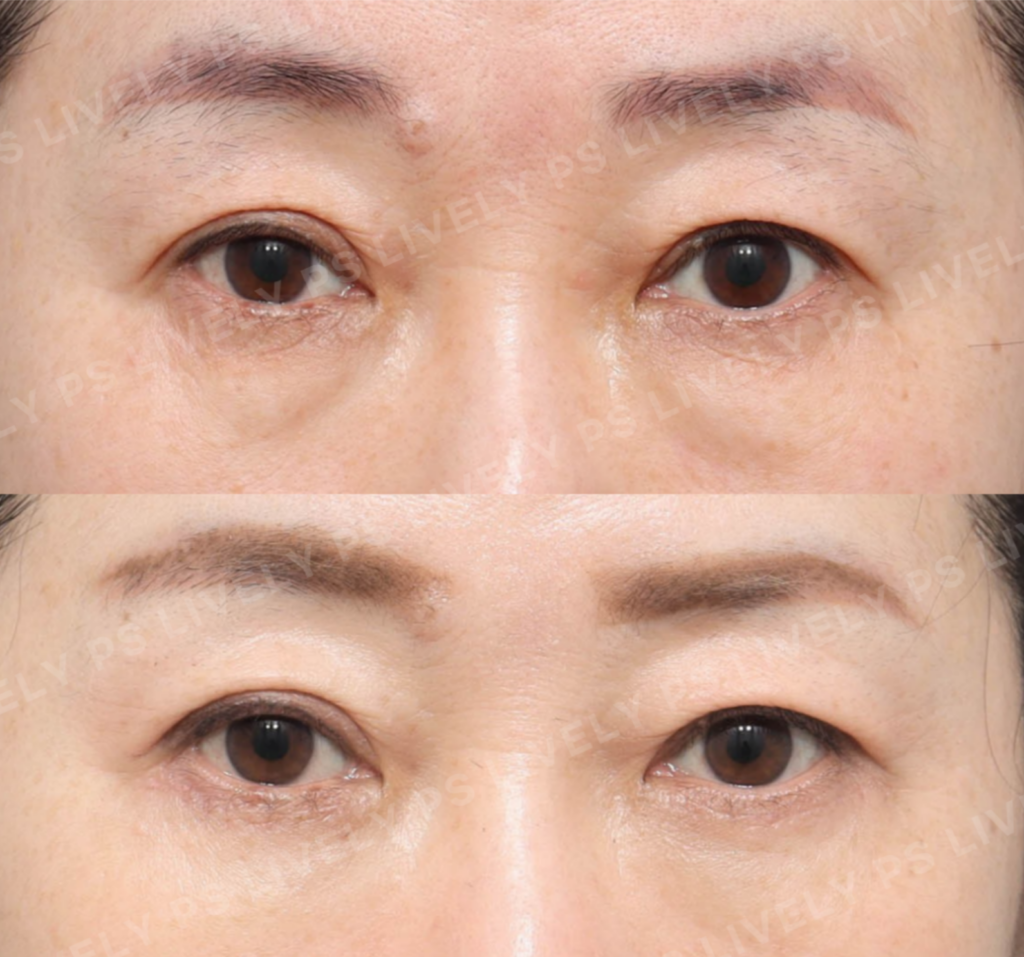 lower blepharoplasty before/after