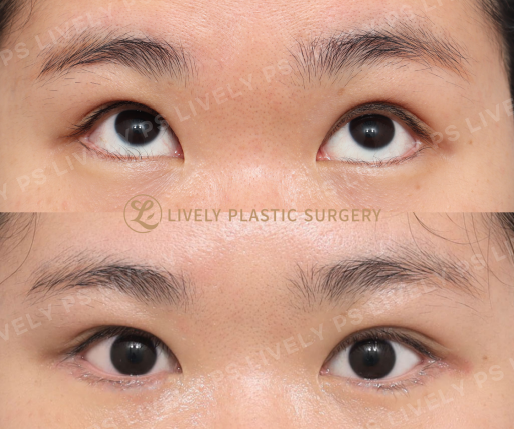 Entropion Surgery