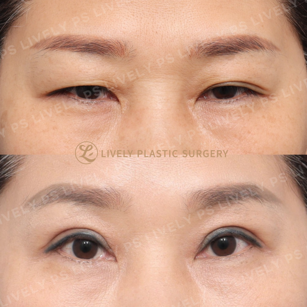 upper blepharoplasty