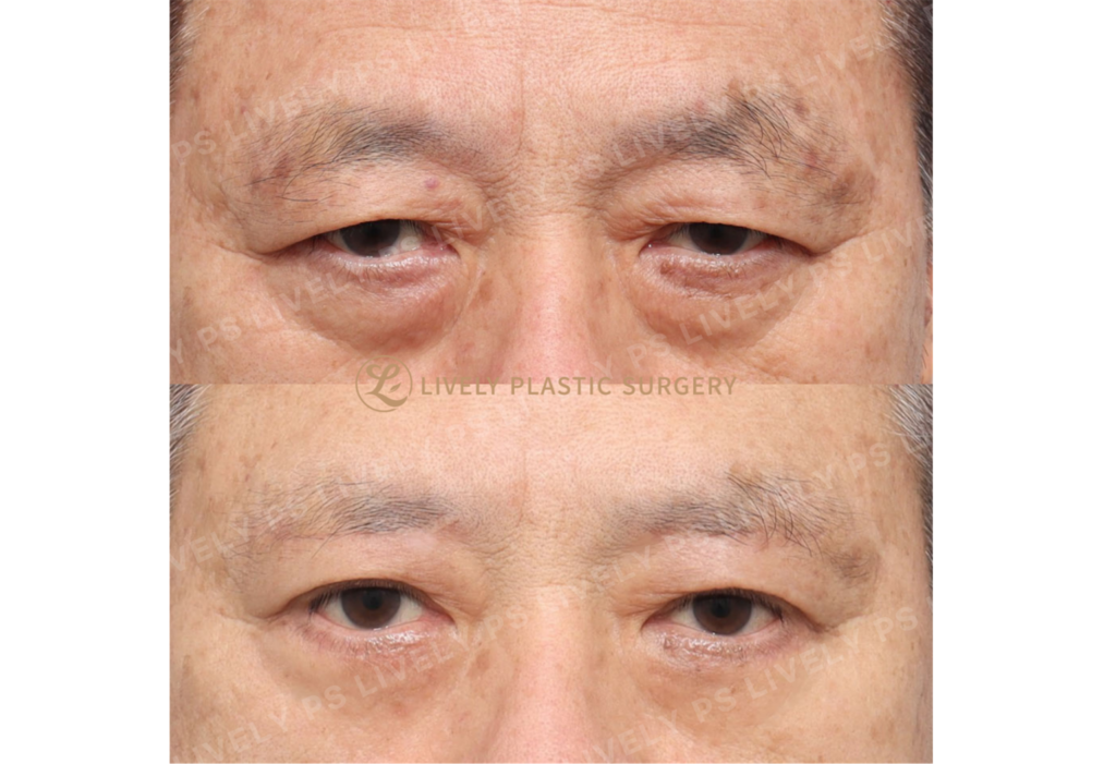 Sub-brow lift, pre / postoperation 1 month