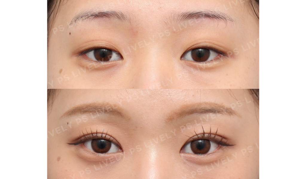 run-proof blepharoplasty