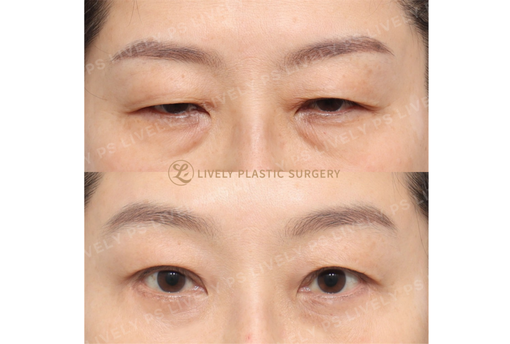 endoscopic brow lift