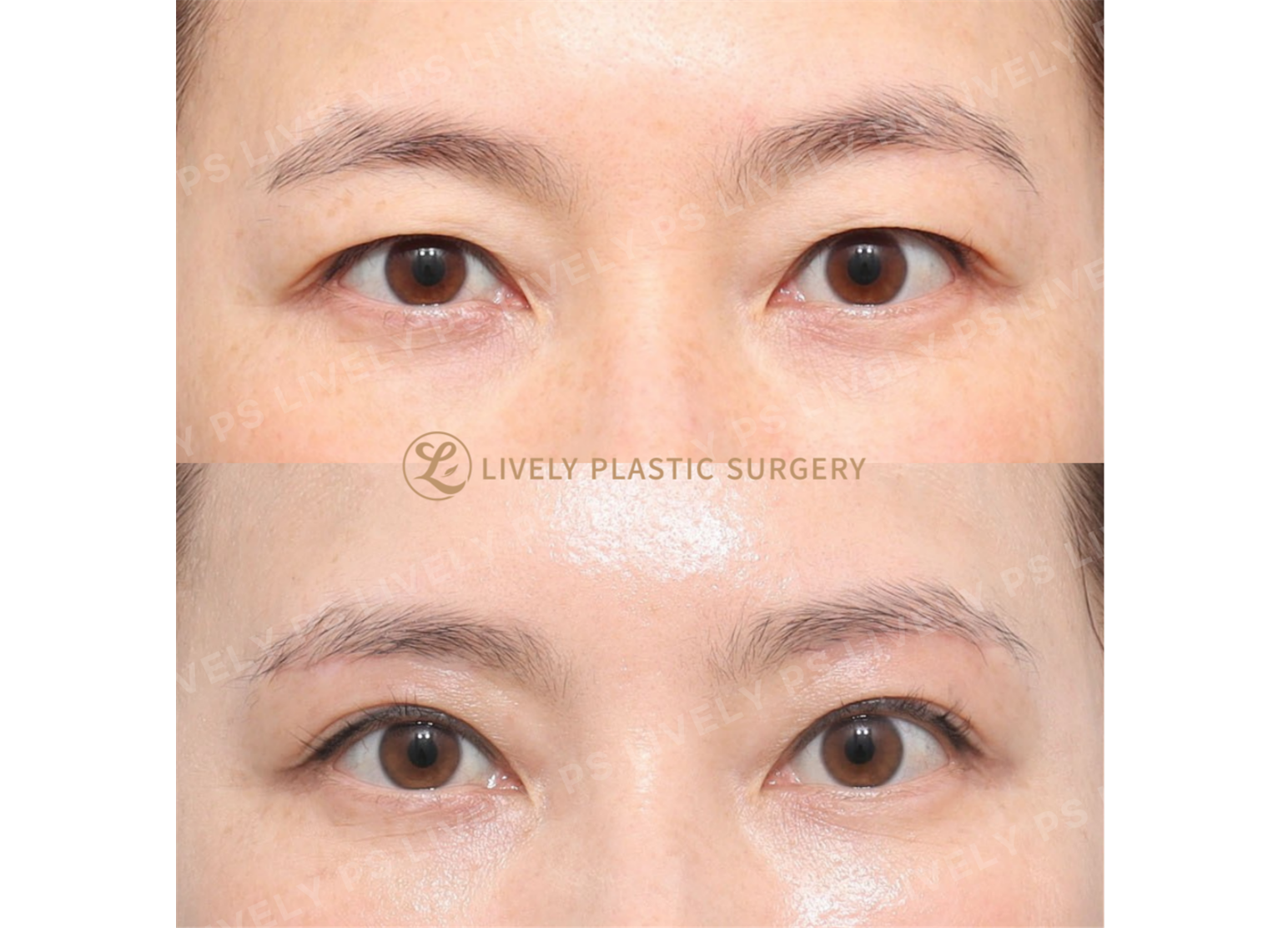 Sub-brow Lift review